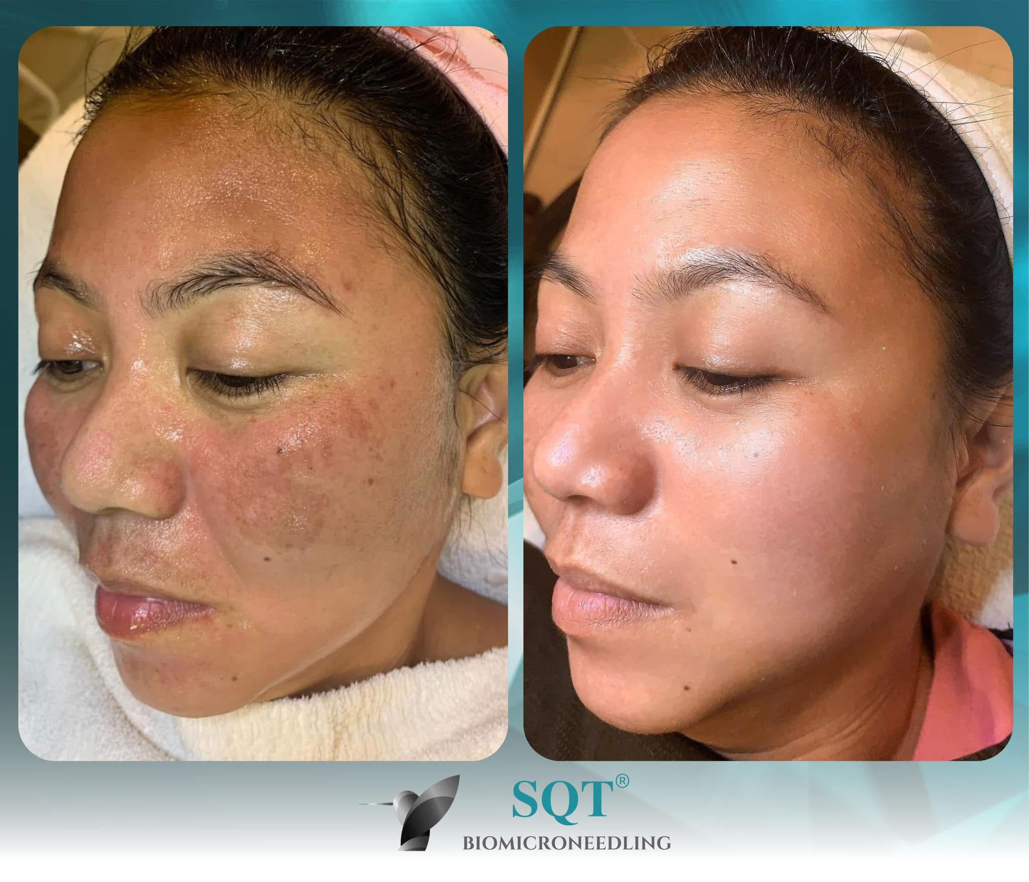 Facial